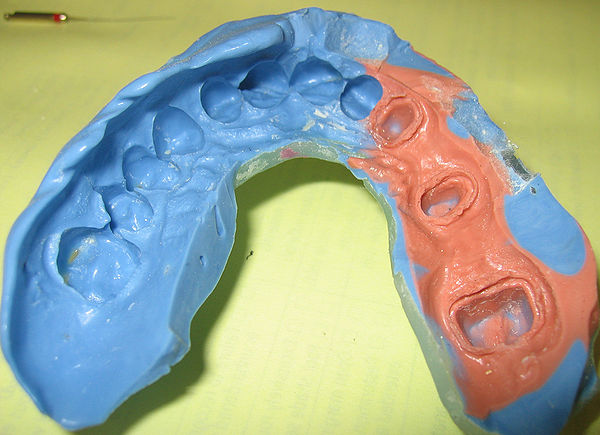 Dental Imprint in Preparation for Crowns